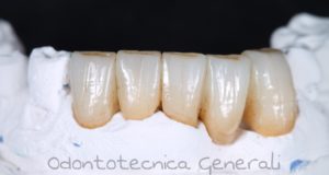 Ponte in zirconia anatomica Nuance a durezza e traslucenza progressiva 1200/600 mpa, infiltrato pre sintering