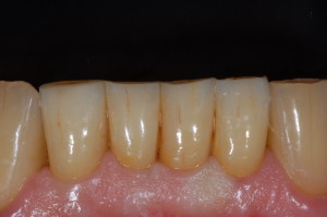 4 el. in zirconia monolitica traslucente con tecnica di pittura superficiale