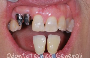 Protesi fissa in metallo ceramica con supporto implantare