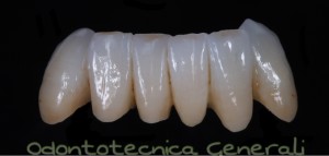 Gruppo frontale inferiore di 6 elementi, da 33 a 43, realizzati in zirconia monolitica traslucente multilayering